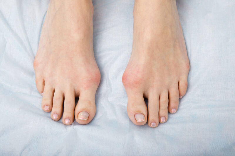 hallux-valgus-kleines-Bild Füße mit dem Hallux Valgus Syndrom